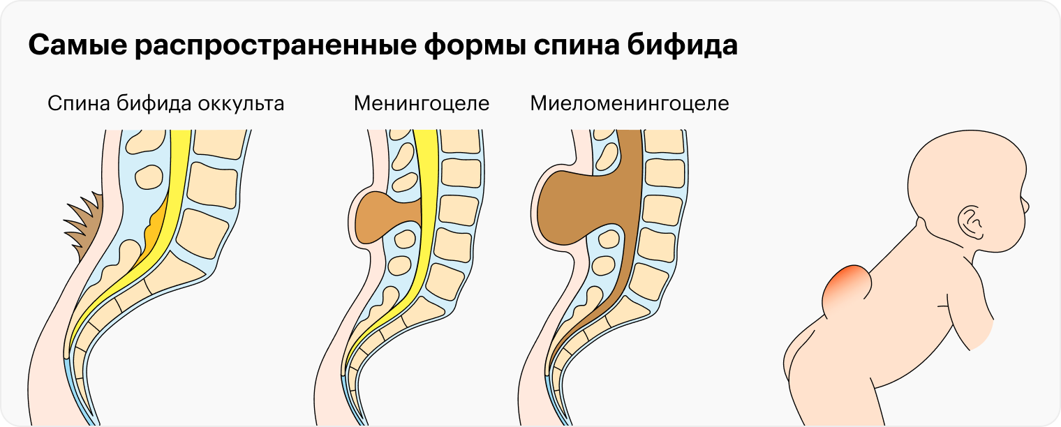 Спина бифида фонд. Расщепление позвоночника.